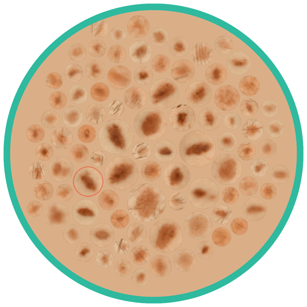 The SpotDoc spot map: dozens of magnified skin spots from one scan arranged in a single circular view, with one spot circled for follow-up