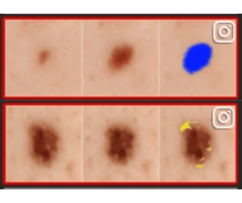 Early skin cancer detection technology