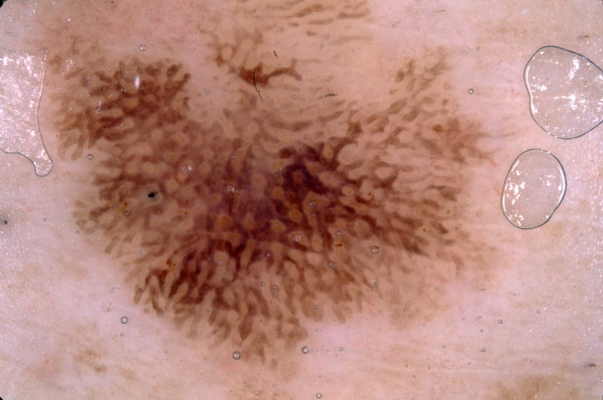 Dermoscopic close-up of a seborrheic keratosis showing brown ridges and pale rounded openings.