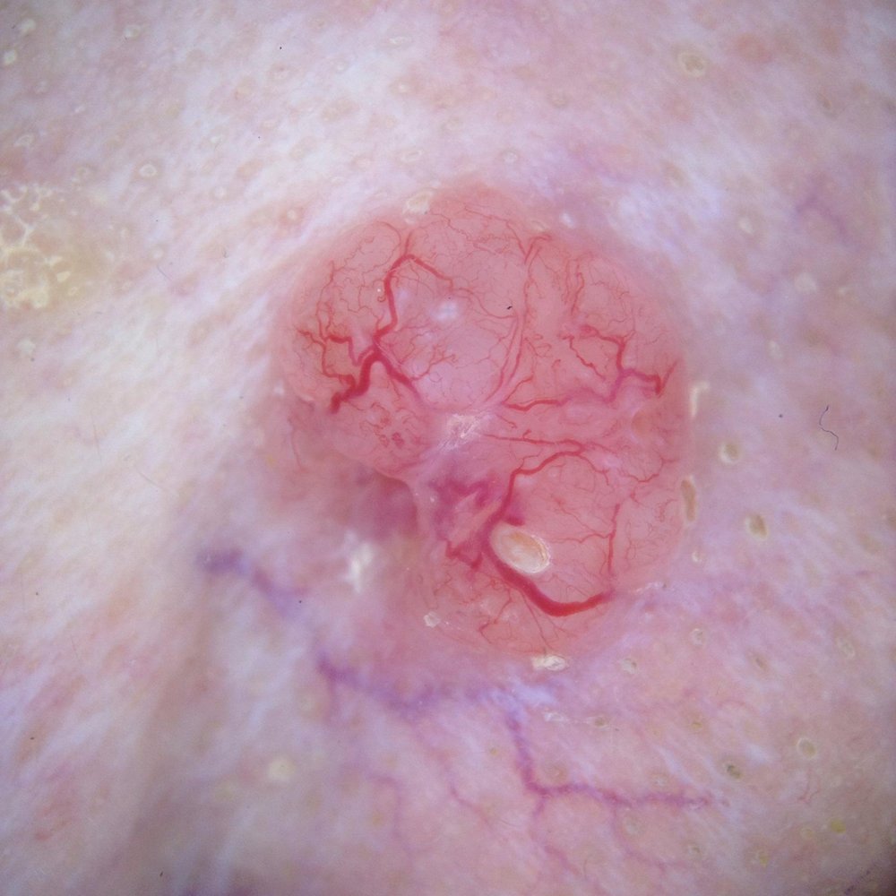 Close-up of a nodular basal cell carcinoma — a pearly, translucent pink bump with fine branching blood vessels on sun-damaged skin.