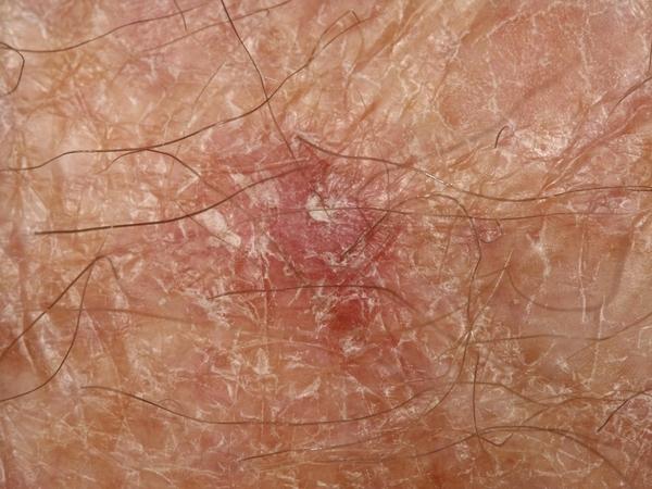Close-up of a squamous cell carcinoma: a firm, red, scaly patch with crusting on chronically sun-damaged skin.